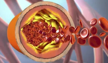 8 formas de bajar el colesterol y limpiar tus arterias