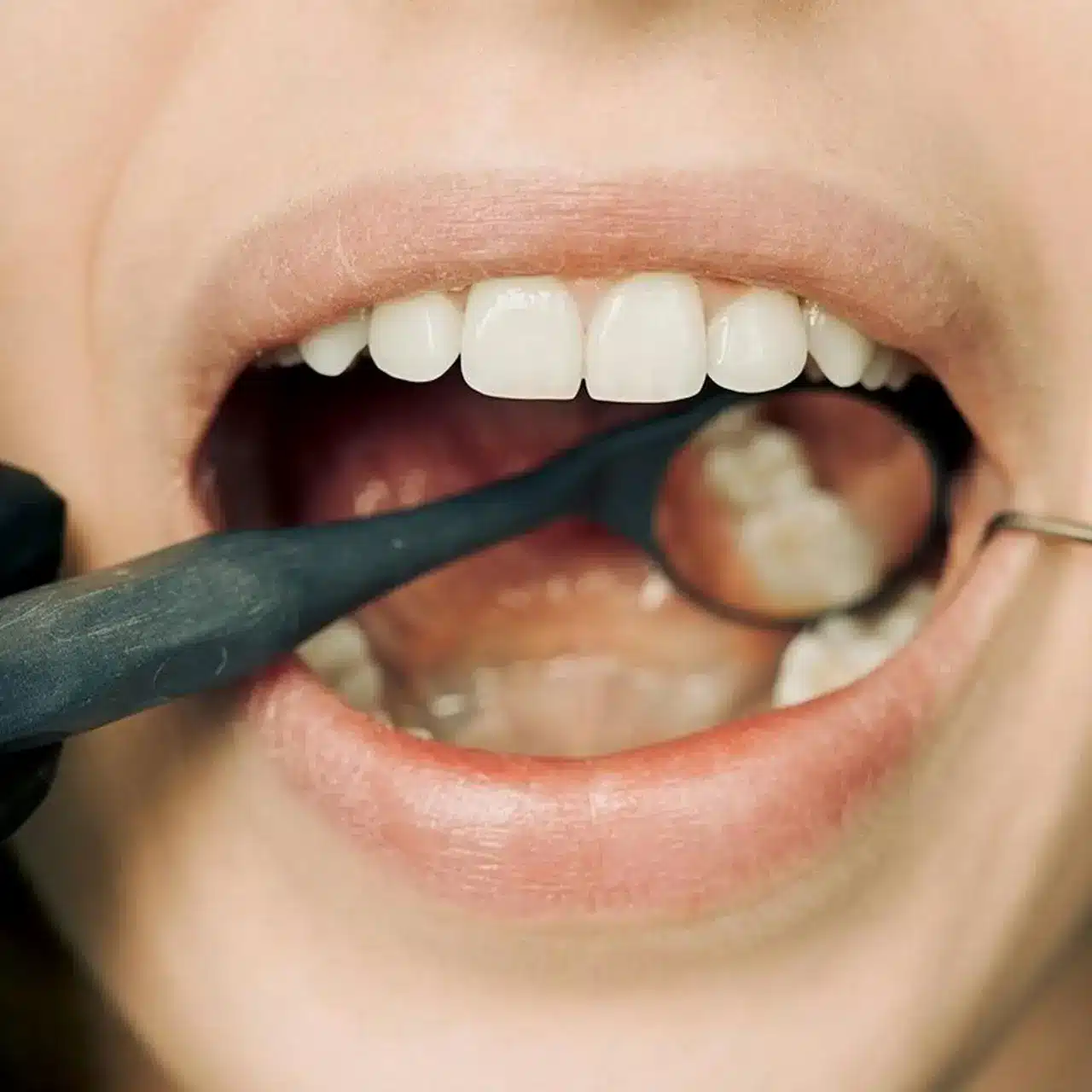 las caries