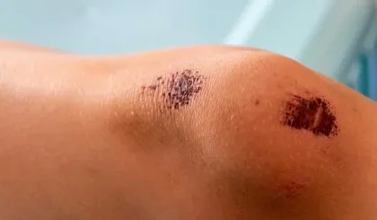 como funciona la cicatrizacion